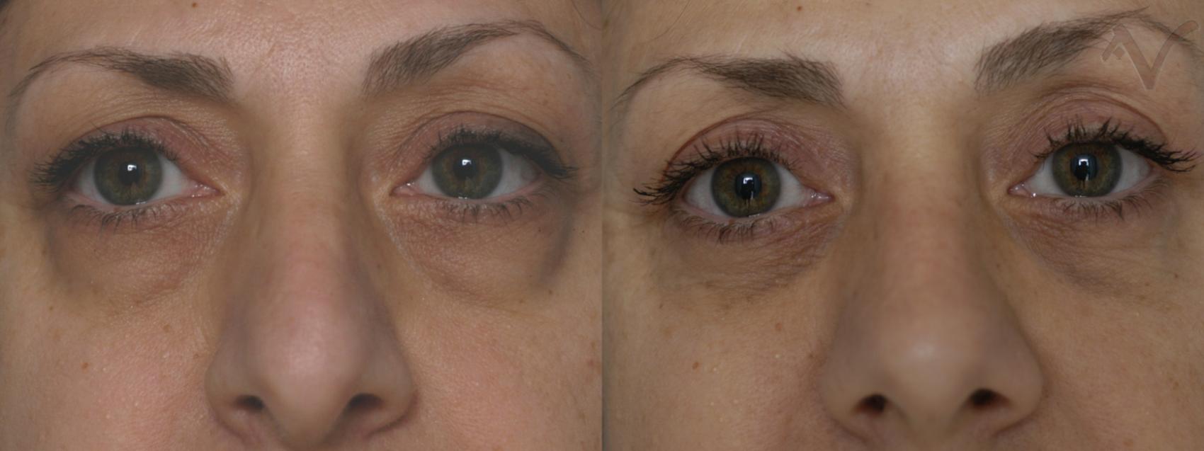 Before & After Lower Eyelid Surgery Case 340 Front View in Los Angeles, CA
