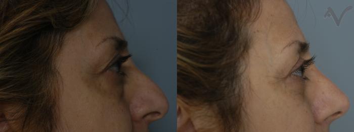 Before & After Lower Eyelid Surgery Case 340 Right Side View in Los Angeles, CA