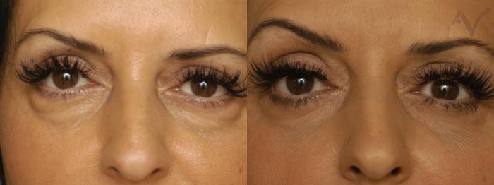 Before & After Lower Eyelid Surgery Case 343 Front View in Los Angeles, CA