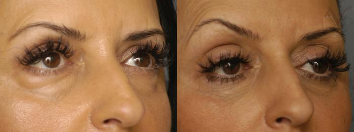 Before & After Lower Eyelid Surgery Case 343 Right Oblique View in Los Angeles, CA
