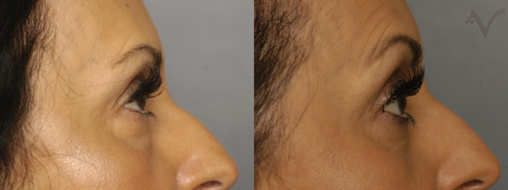 Before & After Lower Eyelid Surgery Case 343 Right Side View in Los Angeles, CA