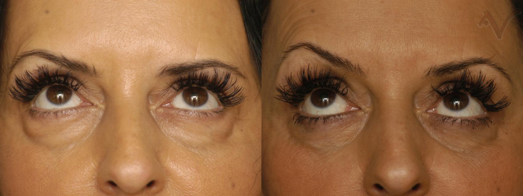 Before & After Lower Eyelid Surgery Case 343 Upward Look View in Los Angeles, CA
