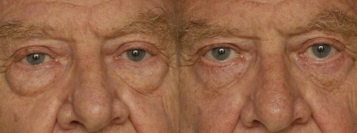 Before & After Lower Eyelid Surgery Case 344 Front View in Los Angeles, CA
