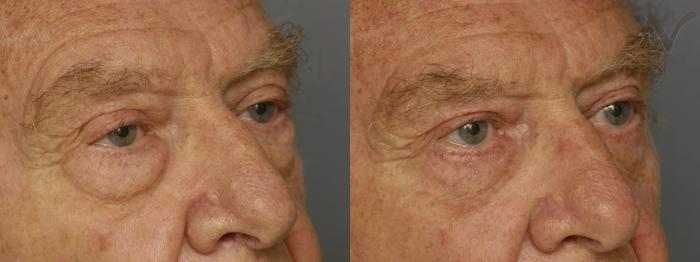 Before & After Lower Eyelid Surgery Case 344 Right Oblique View in Los Angeles, CA