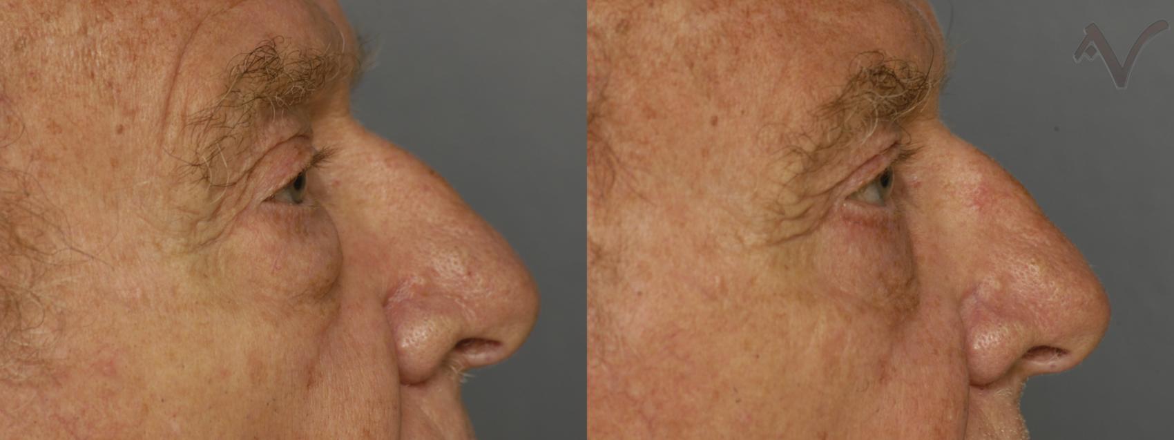 Before & After Lower Eyelid Surgery Case 344 Right Side View in Los Angeles, CA
