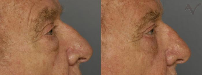 Before & After Lower Eyelid Surgery Case 344 Right Side View in Los Angeles, CA
