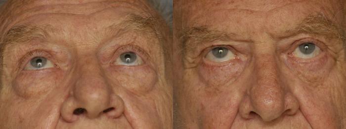 Before & After Lower Eyelid Surgery Case 344 Upward Look View in Los Angeles, CA