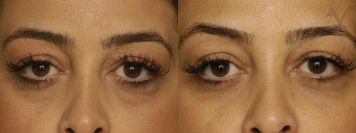 Before & After Lower Eyelid Surgery Case 345 Front View in Los Angeles, CA