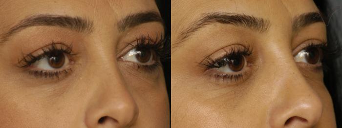 Before & After Lower Eyelid Surgery Case 345 Right Oblique View in Los Angeles, CA