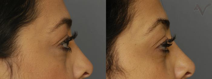 Before & After Lower Eyelid Surgery Case 345 Right Side View in Los Angeles, CA