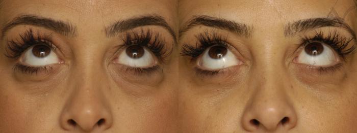 Before & After Lower Eyelid Surgery Case 345 Upward Look View in Los Angeles, CA