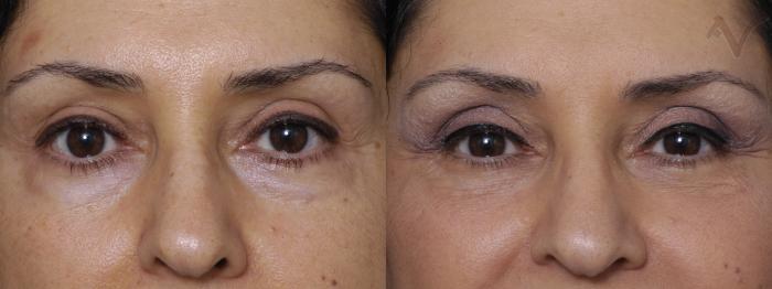 Before & After Lower Eyelid Surgery Case 349 Front View in Los Angeles, CA