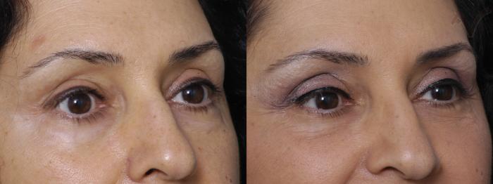 Before & After Lower Eyelid Surgery Case 349 Right Oblique View in Los Angeles, CA