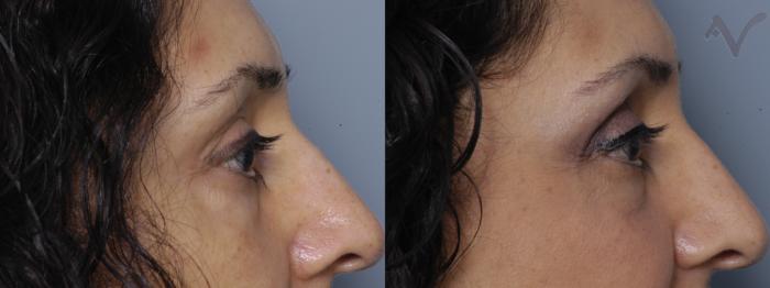 Before & After Lower Eyelid Surgery Case 349 Right Side View in Los Angeles, CA