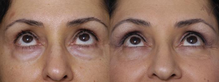 Before & After Lower Eyelid Surgery Case 349 Upward Look View in Los Angeles, CA