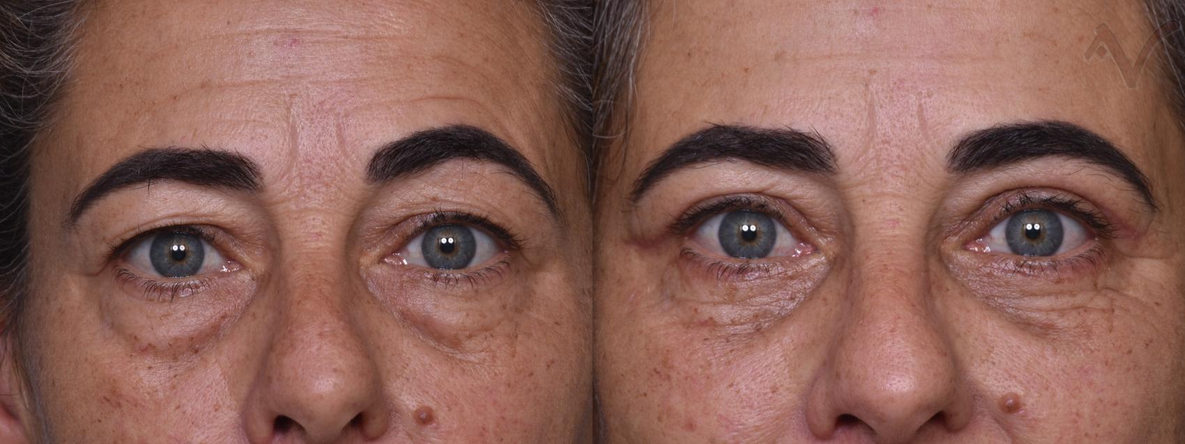 Before & After Lower Eyelid Surgery Case 376 Front View in Los Angeles, CA