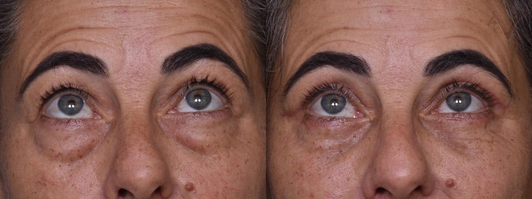 Before & After Lower Eyelid Surgery Case 376 Upward Gaze View in Los Angeles, CA