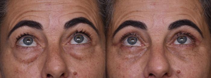 Before & After Lower Eyelid Surgery Case 376 Upward Gaze View in Los Angeles, CA