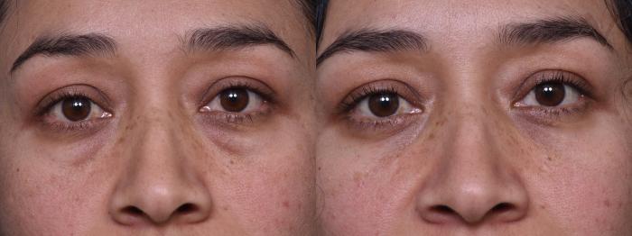 Before & After Lower Eyelid Surgery Case 378 Front View in Los Angeles, CA
