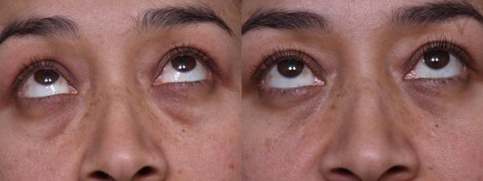 Before & After Lower Eyelid Surgery Case 378 Upward Gaze View in Los Angeles, CA