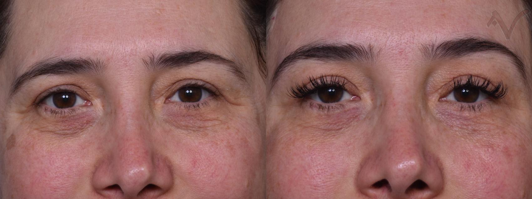 Before & After Lower Eyelid Surgery Case 387 Front View in Los Angeles, CA