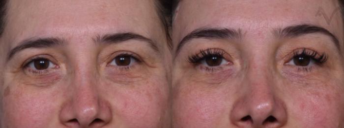 Before & After Lower Eyelid Surgery Case 387 Front View in Los Angeles, CA