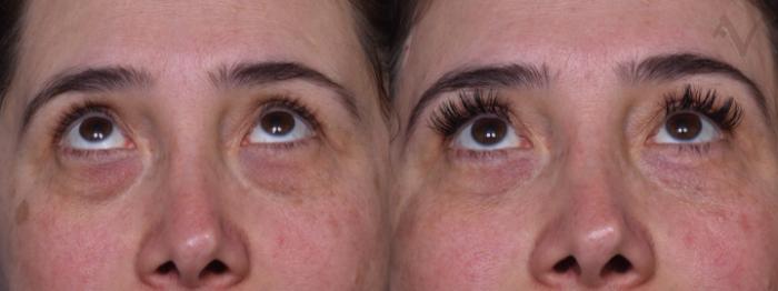 Before & After Lower Eyelid Surgery Case 387 Upward Gaze View in Los Angeles, CA