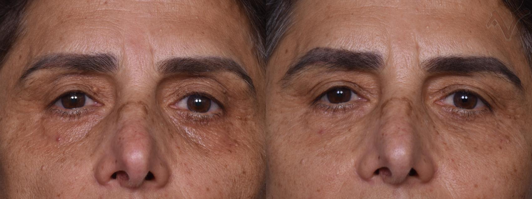 Before & After Lower Eyelid Surgery Case 438 Front View in Los Angeles, CA