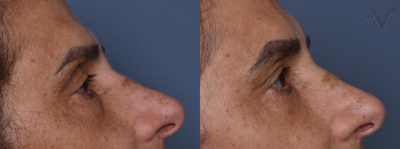 Before & After Lower Eyelid Surgery Case 438 Right Side View in Los Angeles, CA