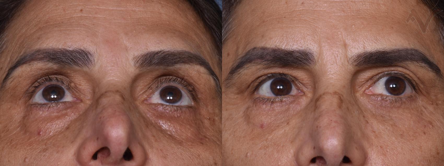 Before & After Lower Eyelid Surgery Case 438 Upward Gaze View in Los Angeles, CA