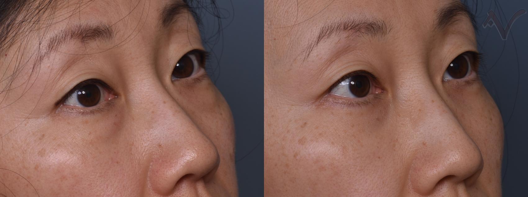 Before & After Lower Eyelid Surgery Case 445 Right Oblique View in Los Angeles, CA