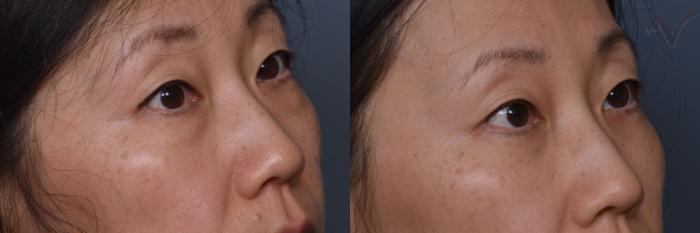 Before & After Lower Eyelid Surgery Case 445 Right Oblique View in Los Angeles, CA