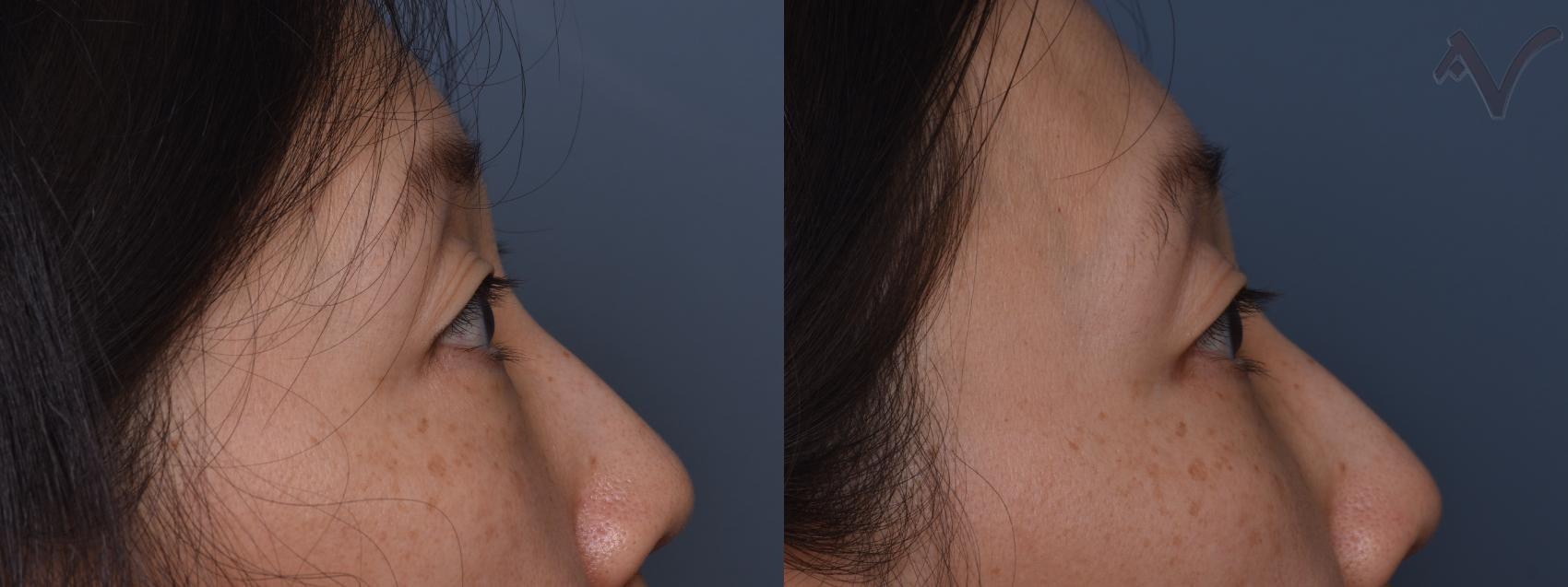 Before & After Lower Eyelid Surgery Case 445 Right Side View in Los Angeles, CA