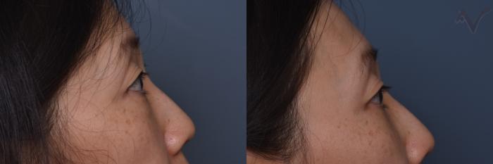Before & After Lower Eyelid Surgery Case 445 Right Side View in Los Angeles, CA