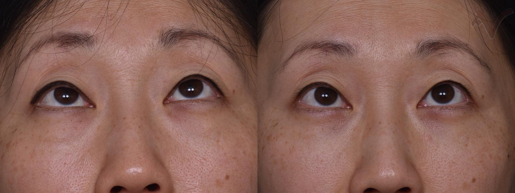 Before & After Lower Eyelid Surgery Case 445 Upward Gaze View in Los Angeles, CA