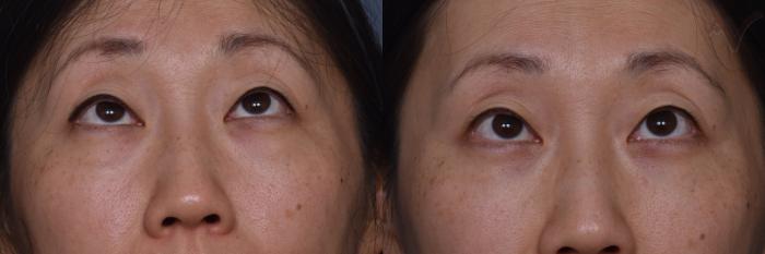 Before & After Lower Eyelid Surgery Case 445 Upward Gaze View in Los Angeles, CA