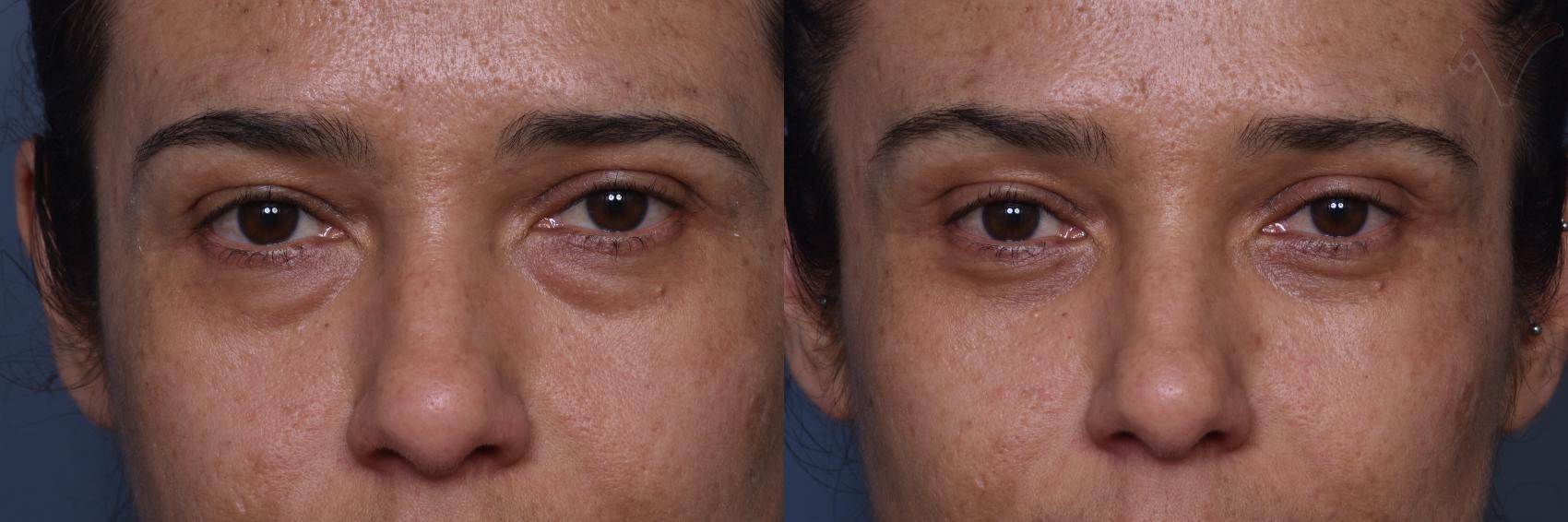 Before & After Lower Eyelid Surgery Case 448 Front View in Los Angeles, CA