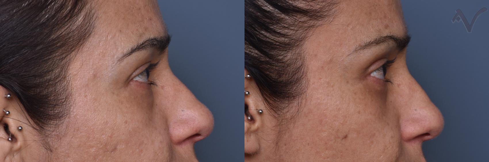 Before & After Lower Eyelid Surgery Case 448 Right Side View in Los Angeles, CA