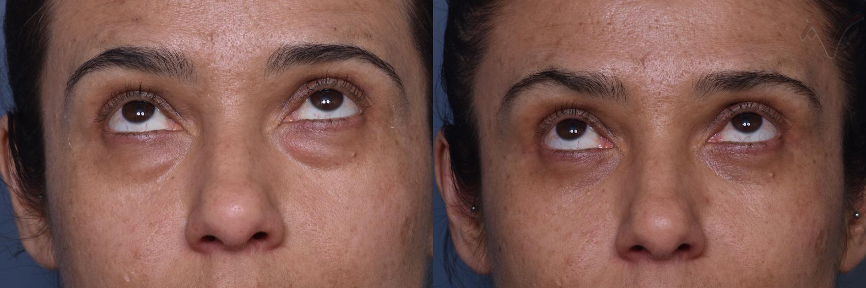 Before & After Lower Eyelid Surgery Case 448 Upward Gaze View in Los Angeles, CA