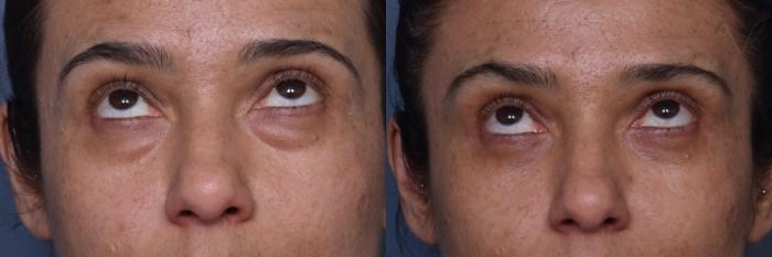 Before & After Lower Eyelid Surgery Case 448 Upward Gaze View in Los Angeles, CA