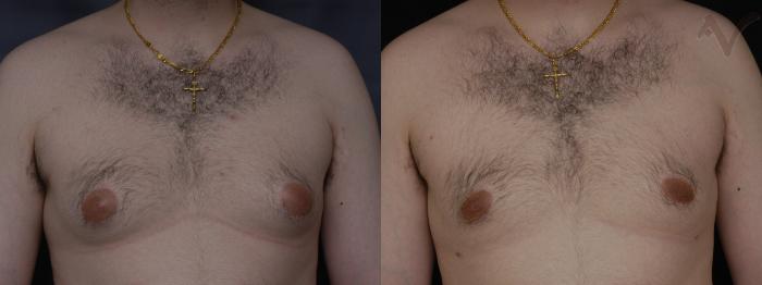 Before & After Male Breast Reduction Case 101 Front View in Los Angeles, CA