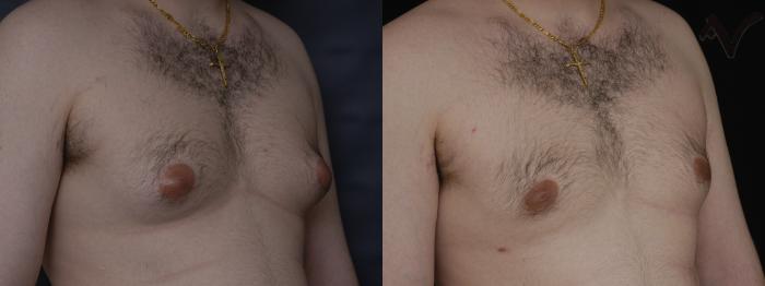 Before & After Male Breast Reduction Case 101 Right Oblique View in Los Angeles, CA