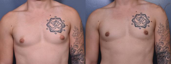Before & After Male Breast Reduction Case 368 Front View in Los Angeles, CA