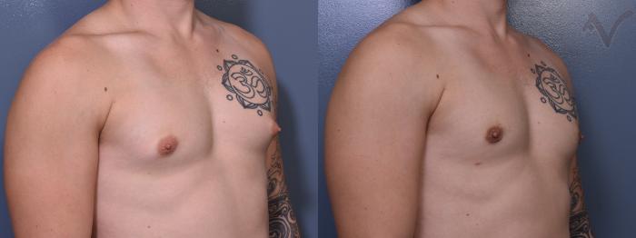 Before & After Male Breast Reduction Case 368 Right Oblique View in Los Angeles, CA