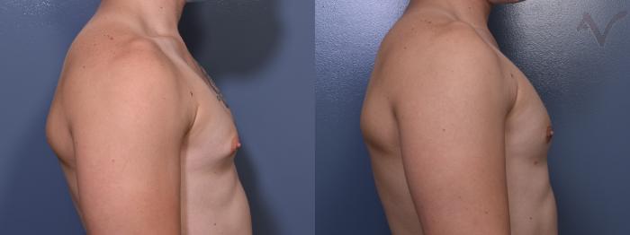 Before & After Male Breast Reduction Case 368 Right Side View in Los Angeles, CA