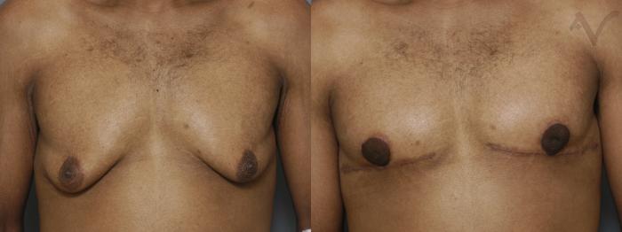 Before & After Male Breast Reduction Case 98 Front View in Los Angeles, CA
