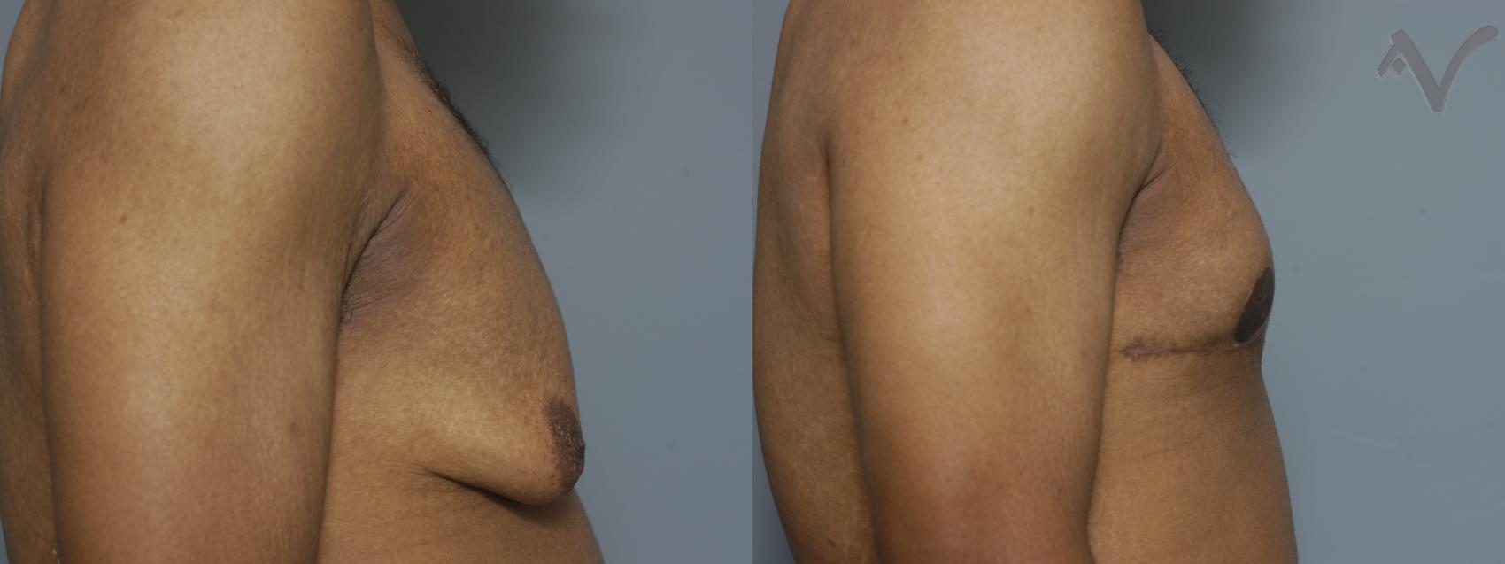 Before & After Male Breast Reduction Case 98 Right Side View in Los Angeles, CA
