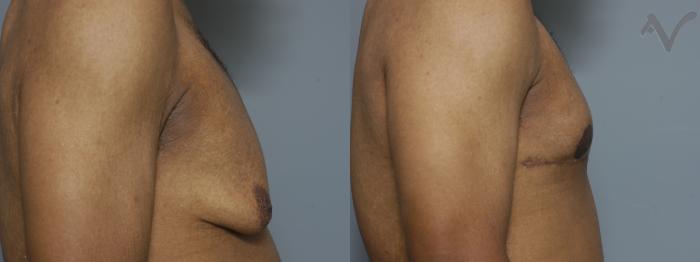 Before & After Male Breast Reduction Case 98 Right Side View in Los Angeles, CA
