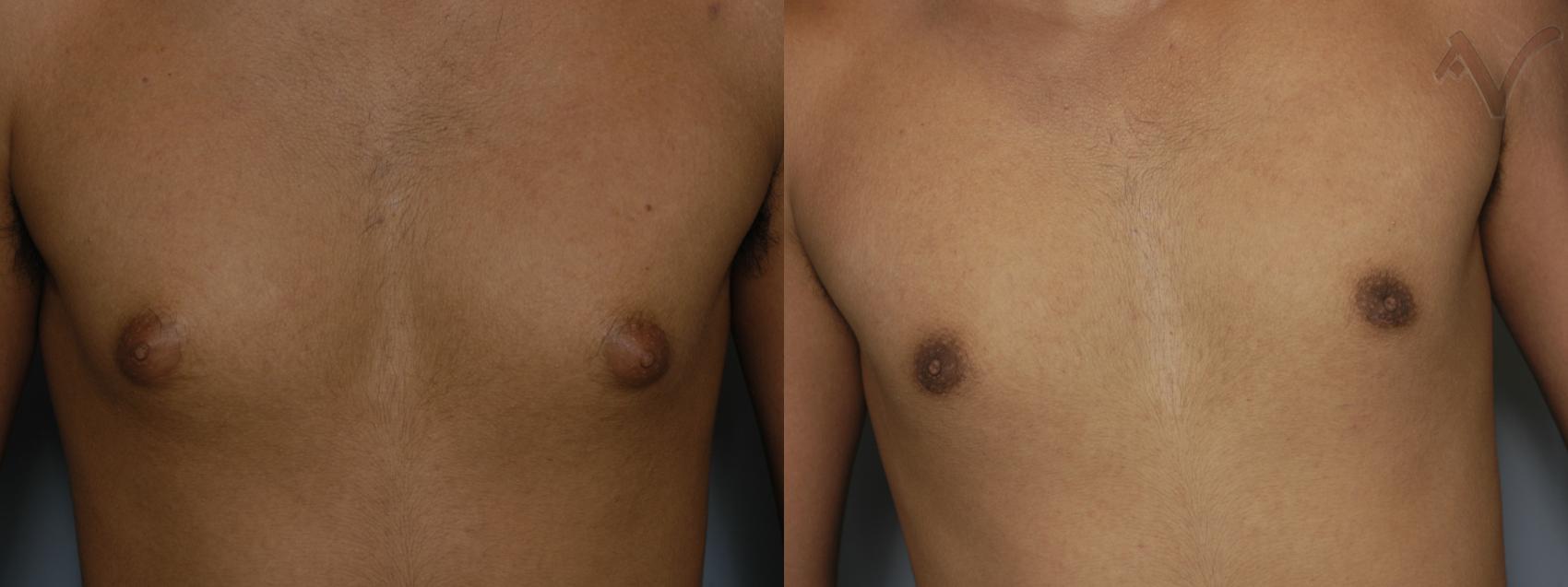 Before & After Male Breast Reduction Case 99 Front View in Los Angeles, CA