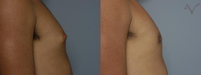 Before & After Male Breast Reduction Case 99 Right Side View in Los Angeles, CA